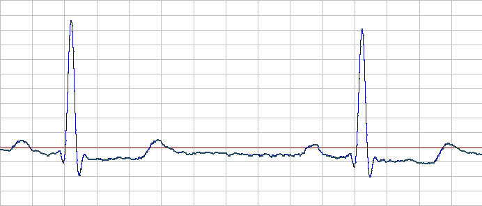 ECG voltage over time